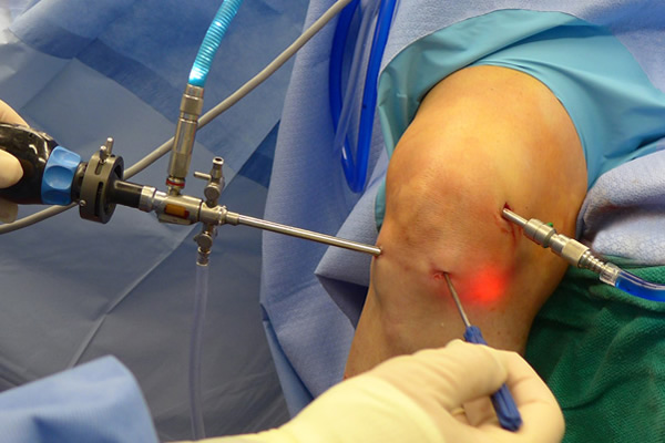 Операция на колено артроскопия